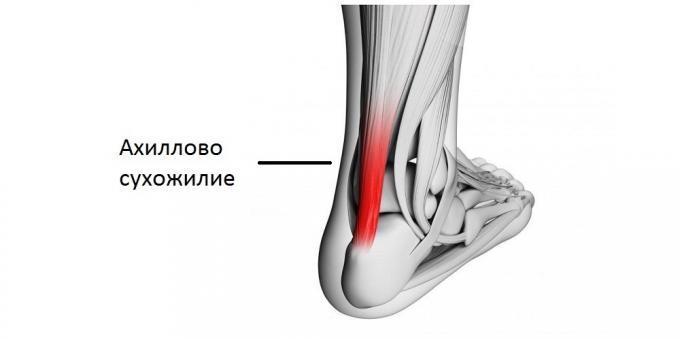 Соре пета: Ахил тендинитиса
