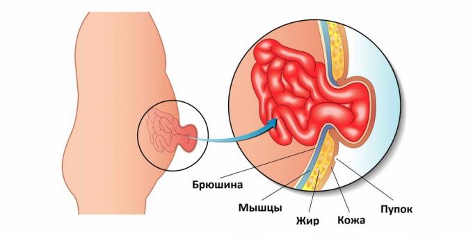 Пупчане кила