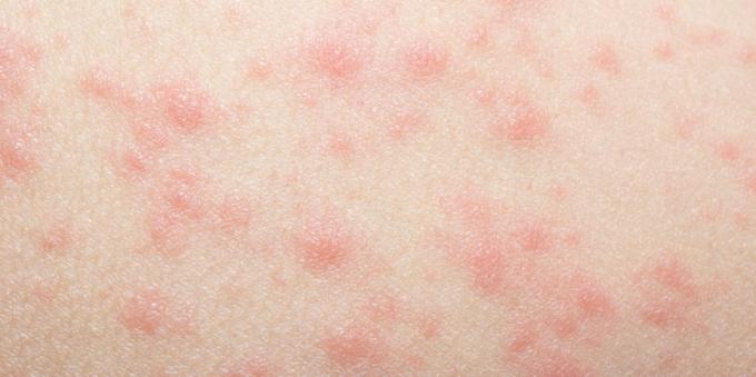 Осип на кожи са алергијама на лекове